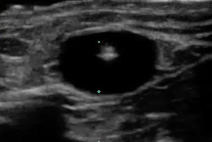 Dialysis Needle into Cannula Image | Sonosite Institute for Point-of
